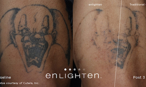 tattoo removal before after mississauga oakville